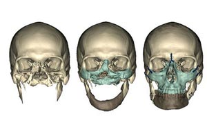 Un craniu imprimat n 3D implantat cu succes unei femei n Belgia